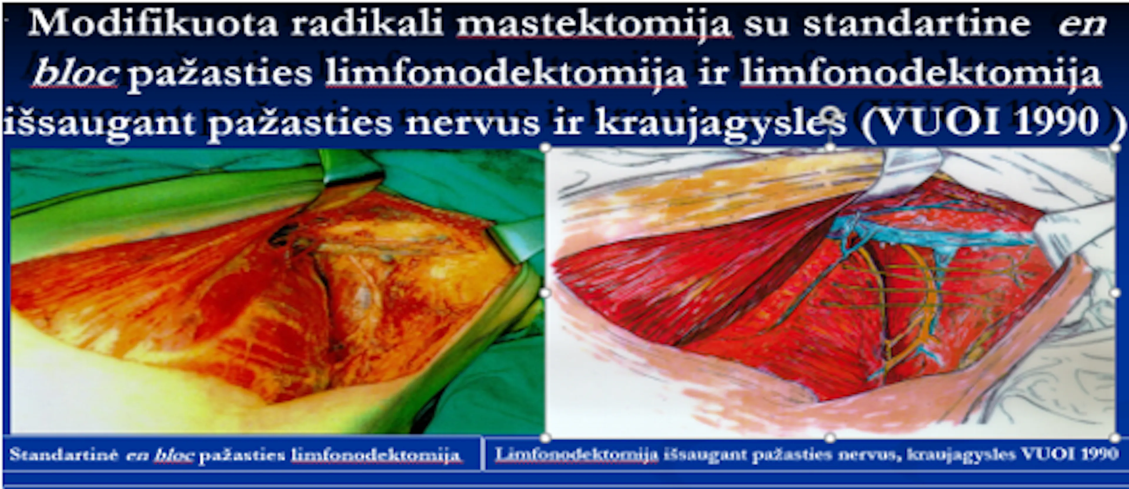 Skaidrė iš V. Ostapenko pranešimo apie krūties vėžio chirurginio gydymo evoliuciją