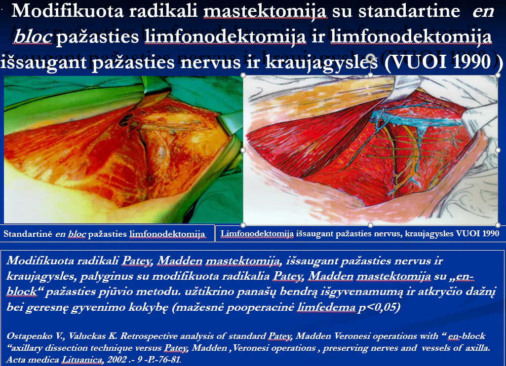 „Modifikuotos radikalios mastektomijos (MRM Patey, Madden) rezultatai: išsaugomi pažasties nervai ir kraujagyslės, panašus išgyvenamumas kaip radikali limfonodektomija, mažesnė pooperacinė limfedema, geresnė pacientų gyvenimo kokybė (1995–2000 m. tyrimai)“