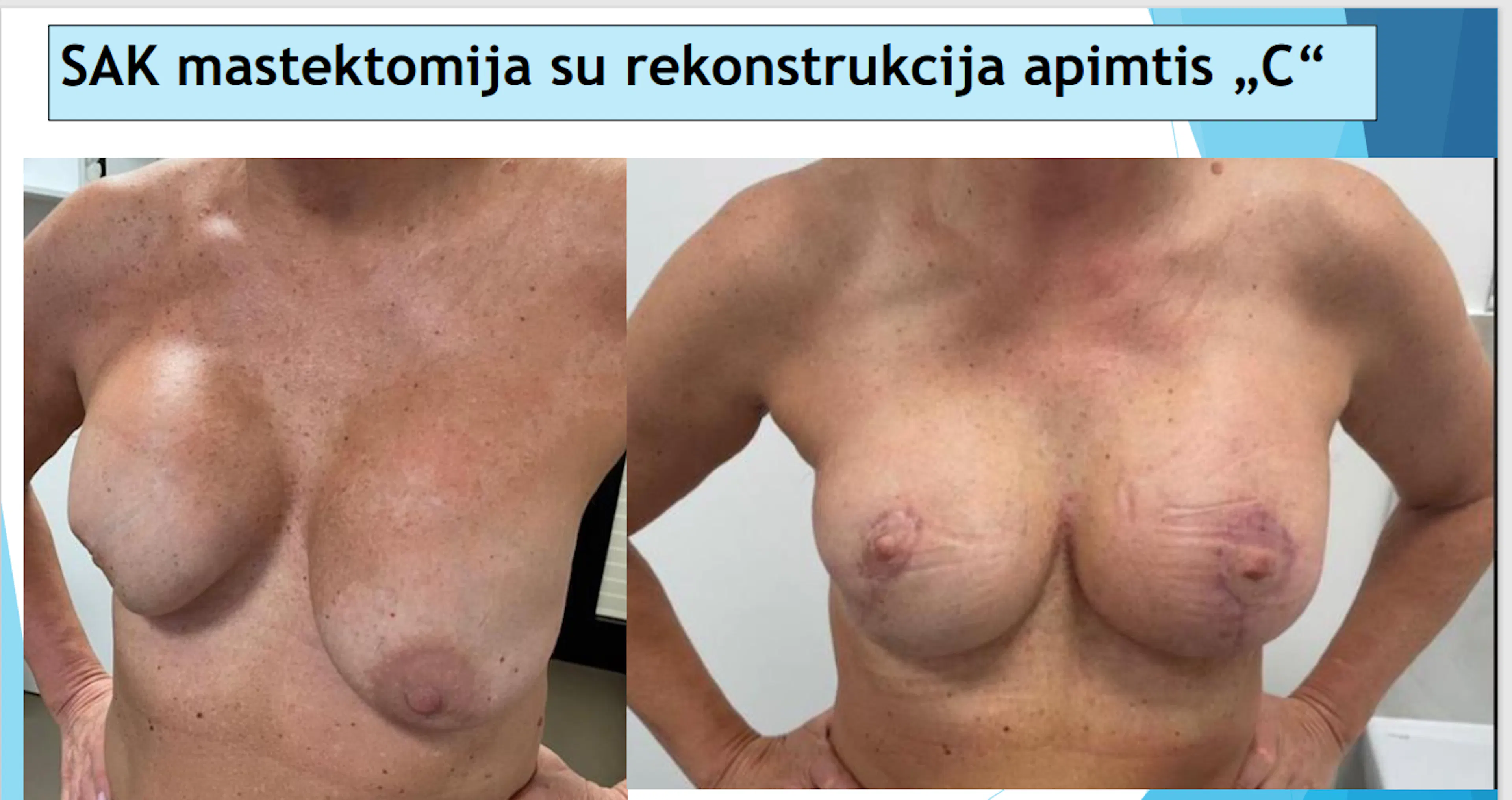 SAK tausojanti mastektomija su vienmomentine krūties rekonstrukcija implantu, esant B arba C tipo krūtų sandarai; pakartotinė rekonstrukcija dėl fibrozės kapsulės kontraktūros.