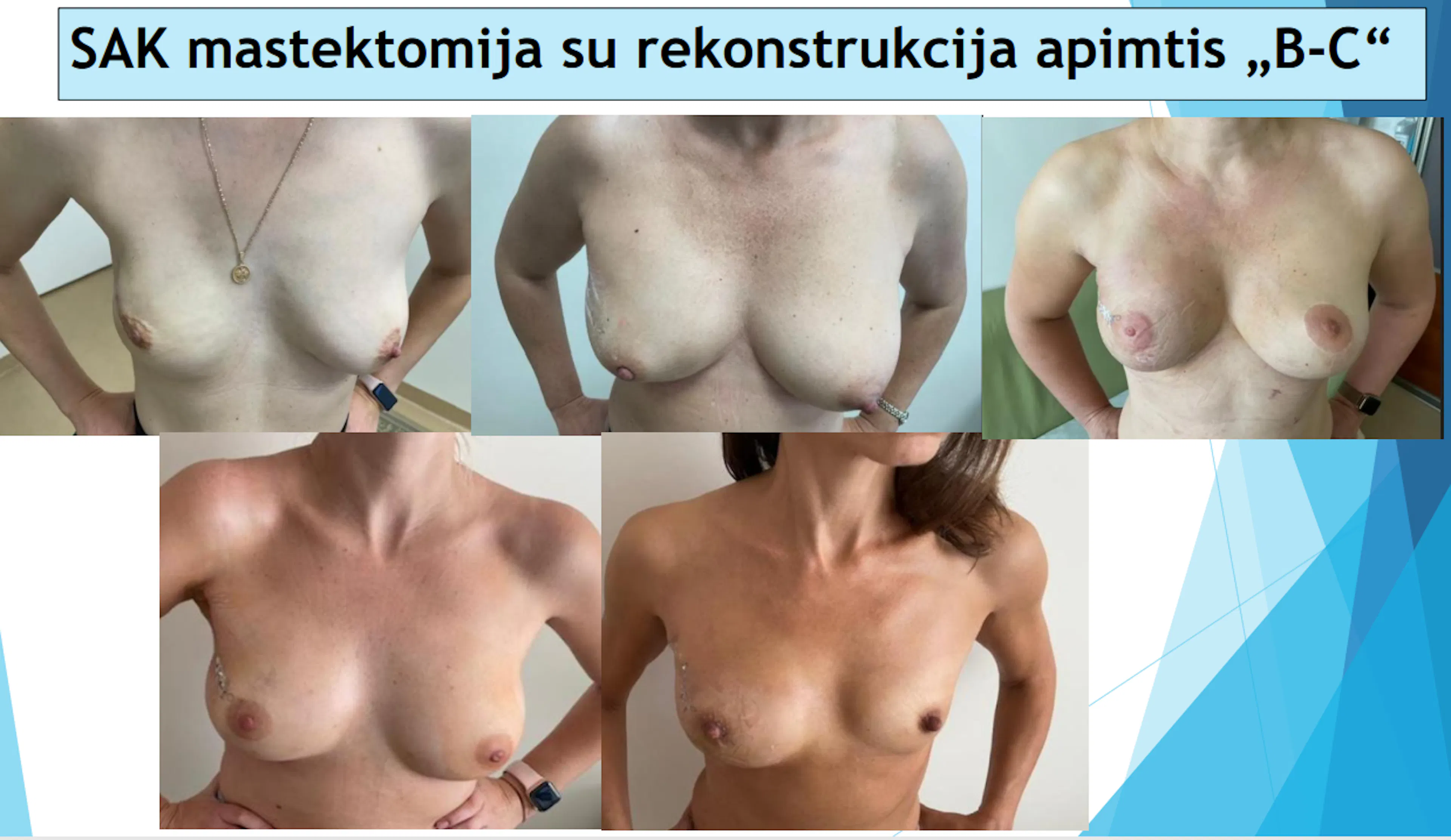 SAK tausojanti mastektomija su krūties rekonstrukcija implantu, esant B arba C tipo krūtų sandarai.