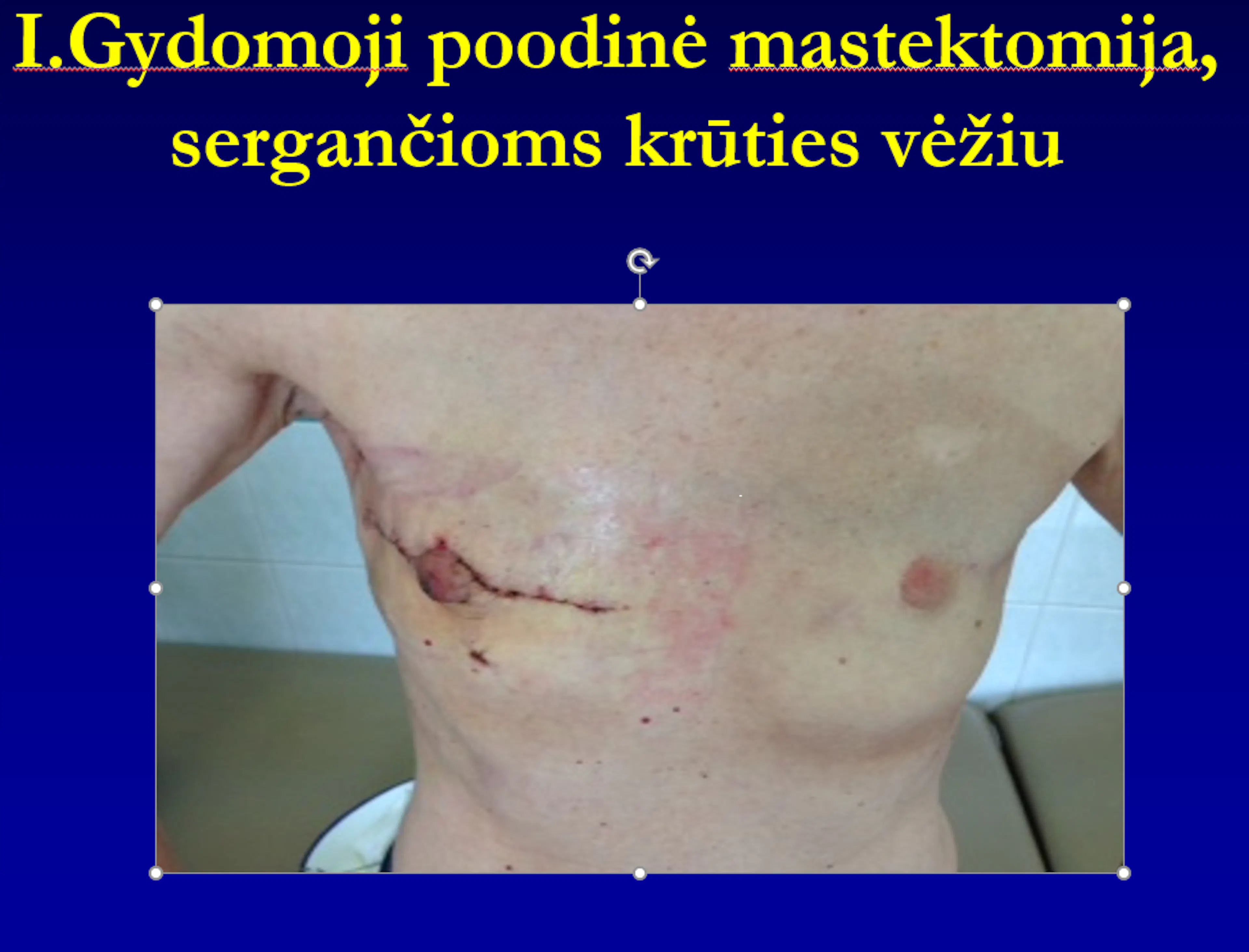 Skaidrė iš V.Ostapenko pranešimo „Poodinė mastektomija“
