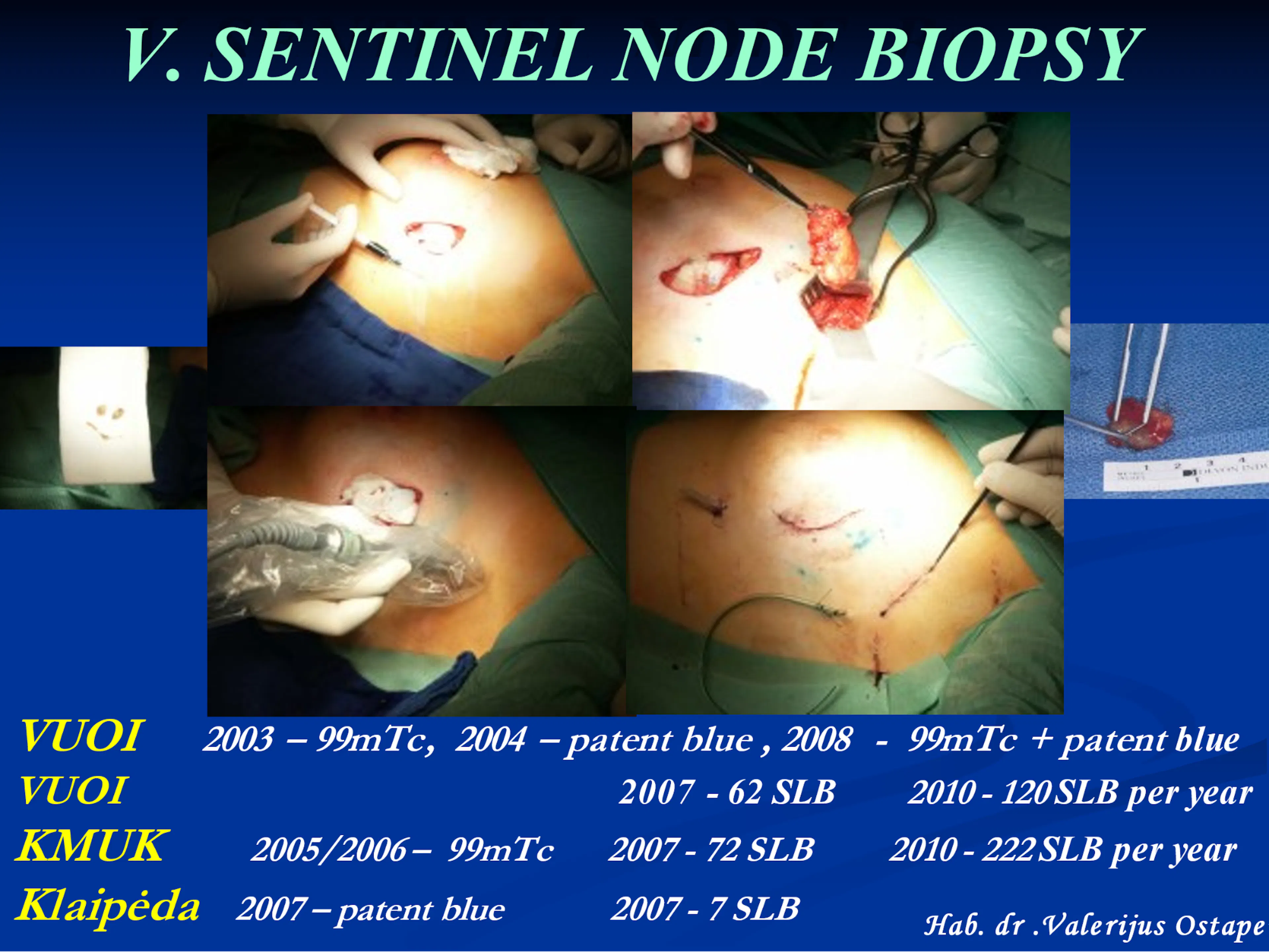 Pirmoji Baltijos šalyse SLB  su dvigubu kontrastavimu