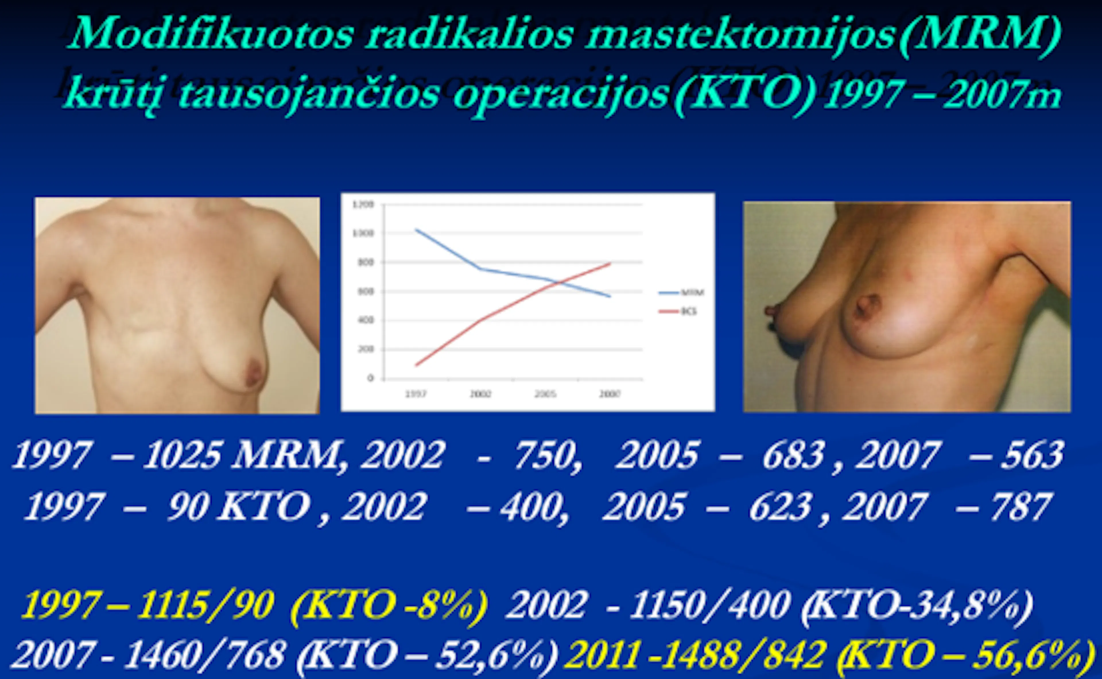 Skaidrė iš V. Ostapenko pranešimo „Krūties vėžio chirurginio gydymo evoliucija“
