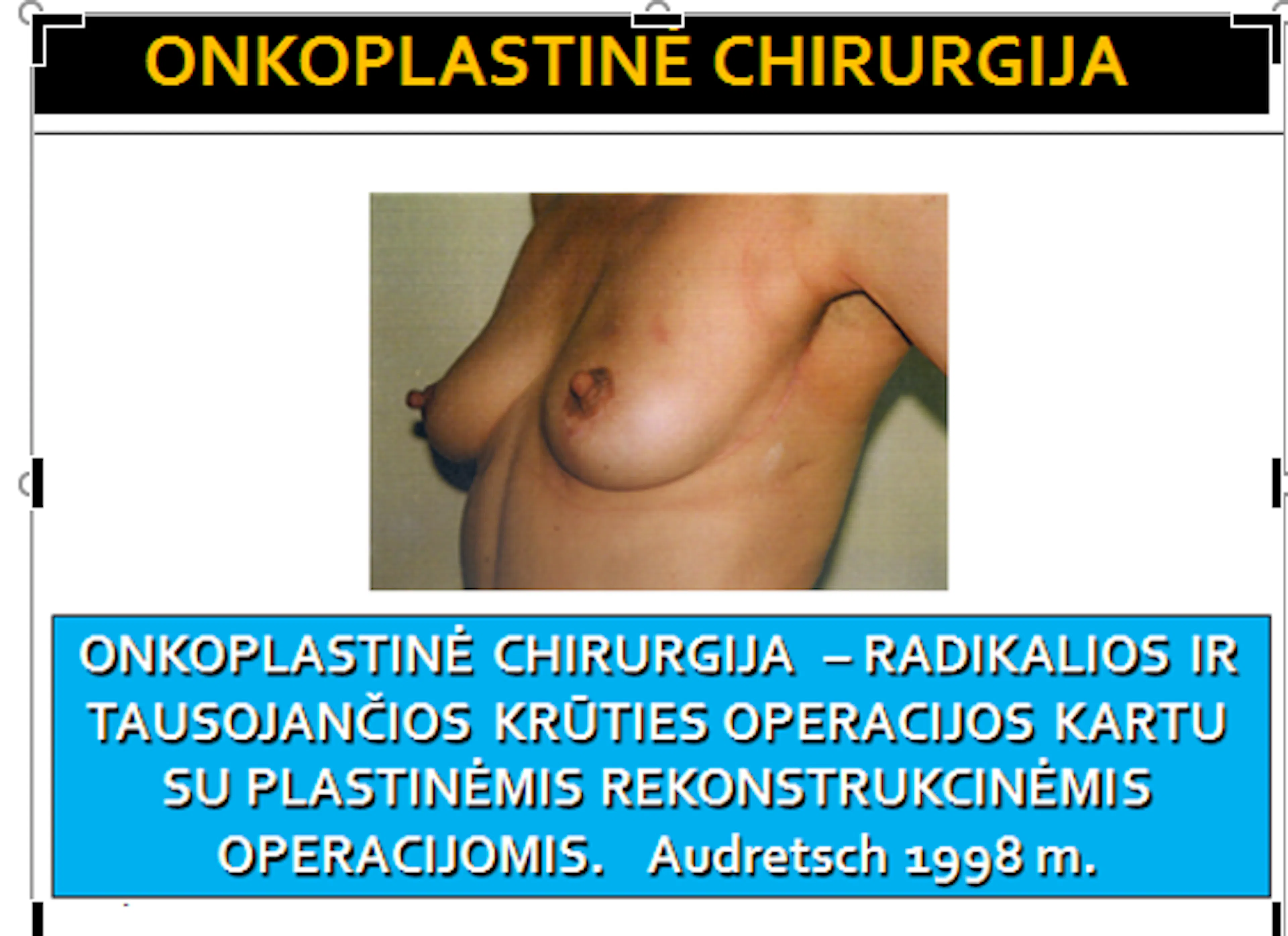 Skaidrė iš V. Ostapenko pranešimo apie onkoplastinės chirurgijos raidą Lietuvoje