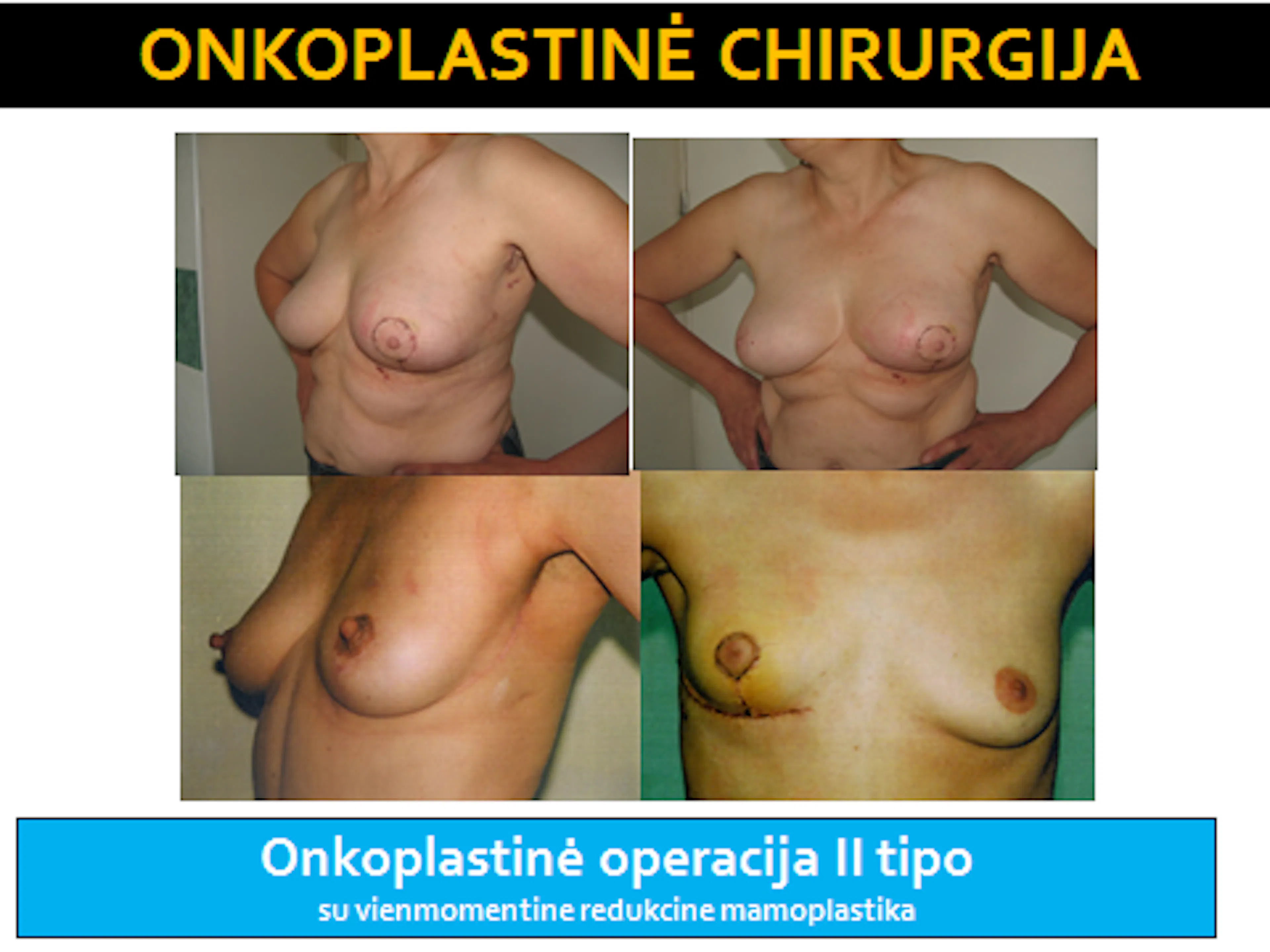 Skaidrė iš V. Ostapenko pranešimo apie onkoplastinės chirurgijos raidą Lietuvoje