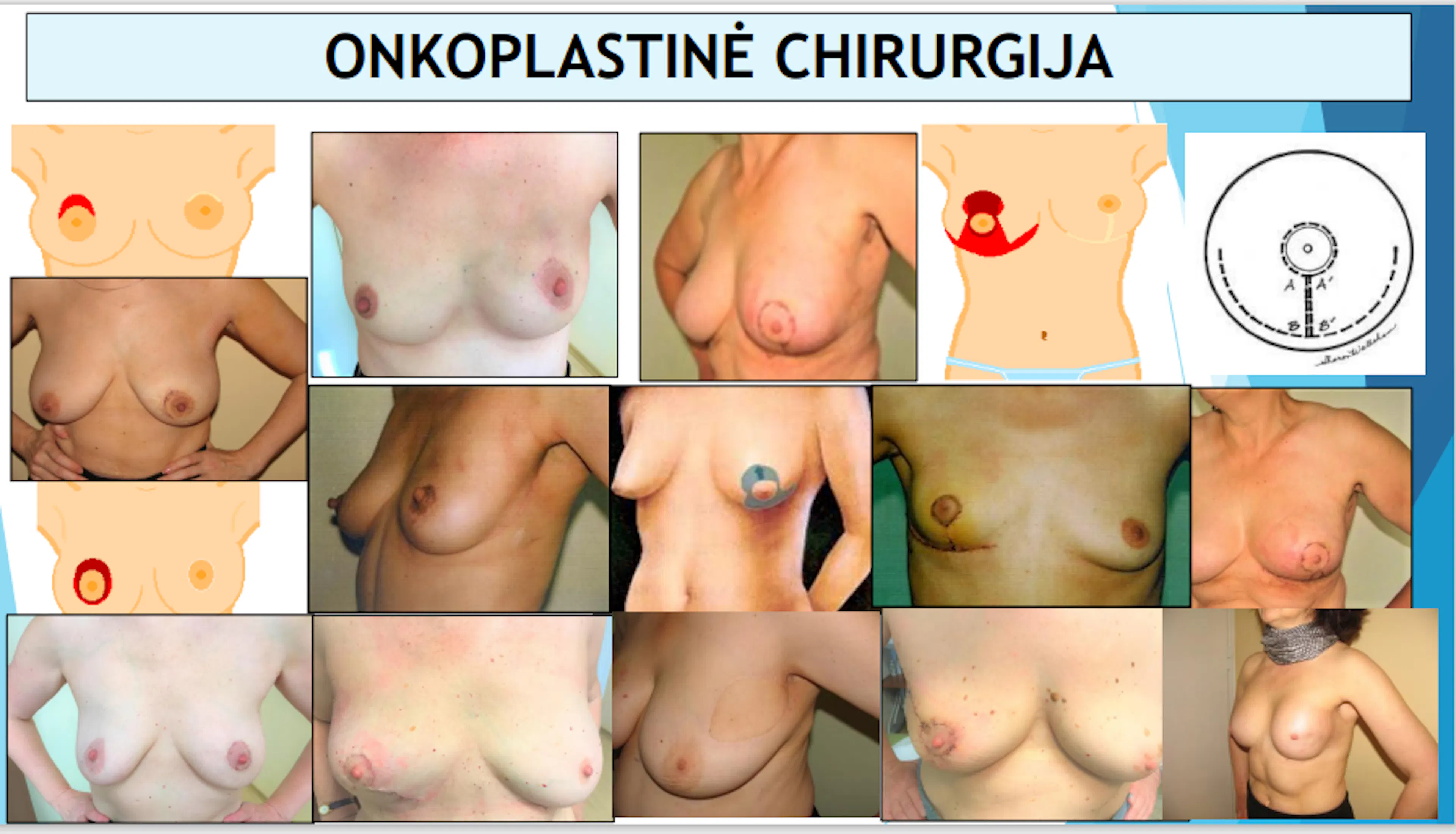 Skaidrė iš V. Ostapenko pranešimo apie onkoplastinės chirurgijos raidą Lietuvoje