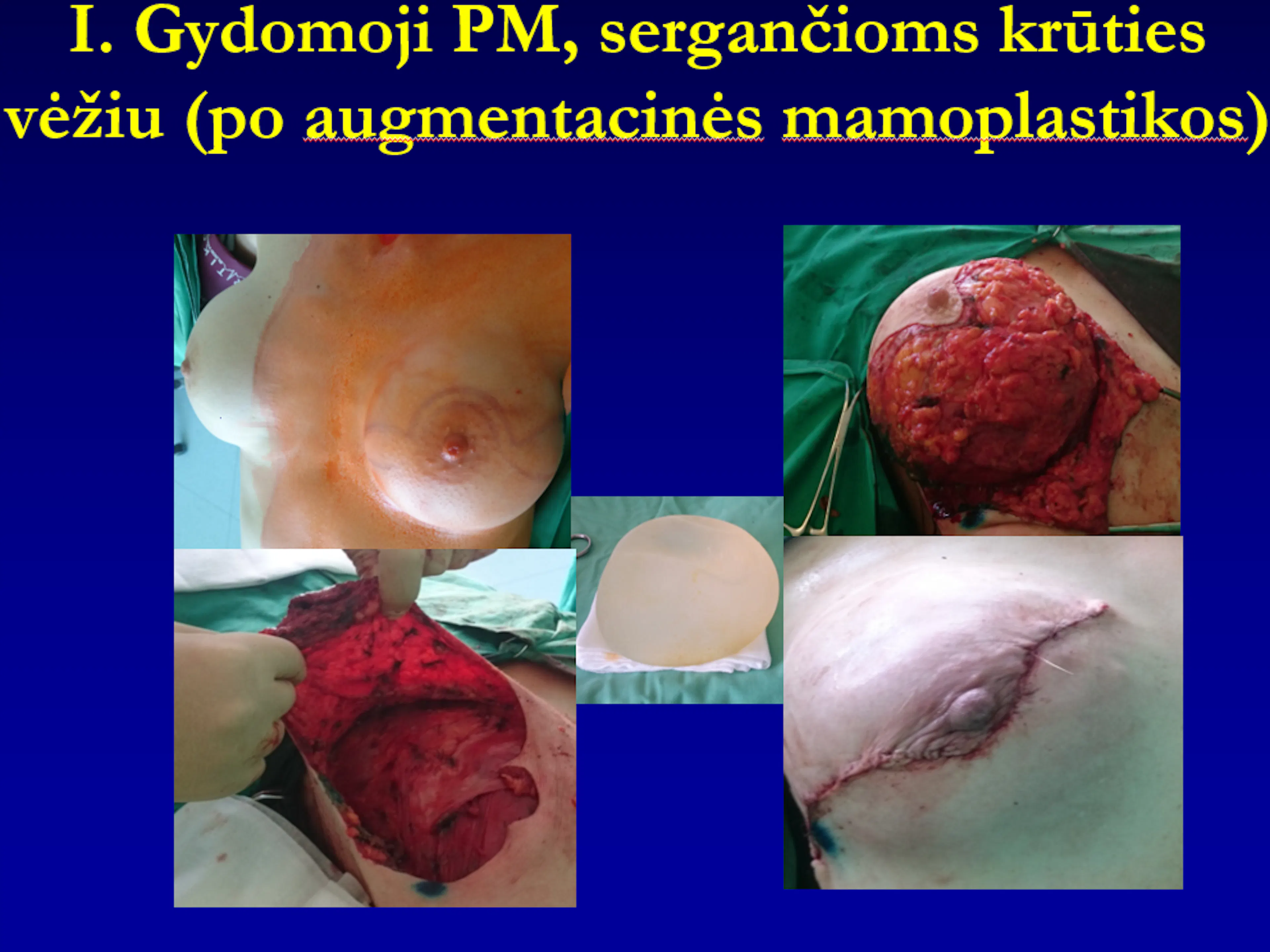 Skaidrė iš V.Ostapenko pranešimo „Poodinė mastektomija“