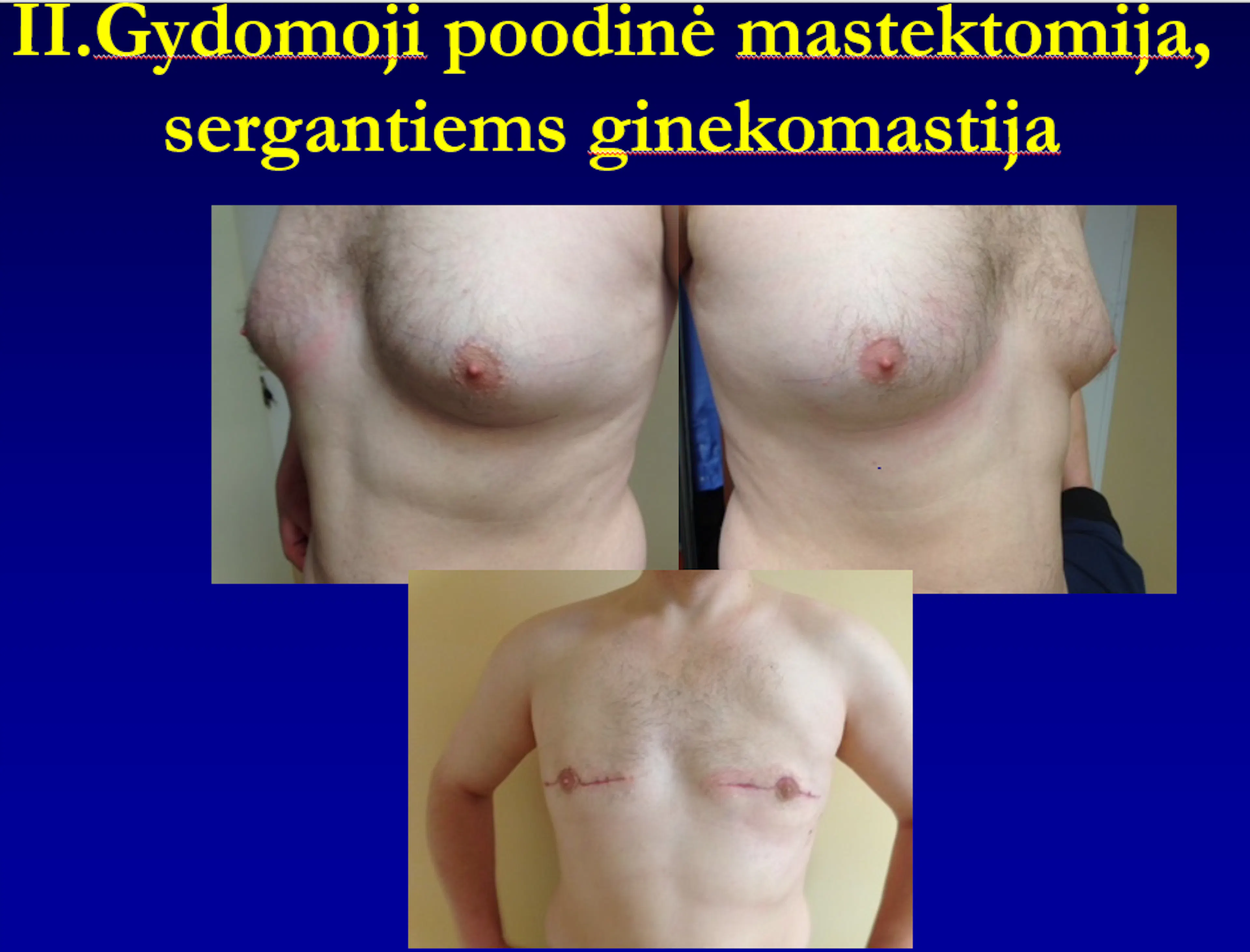 Skaidrė iš V.Ostapenko pranešimo „Poodinė mastektomija“