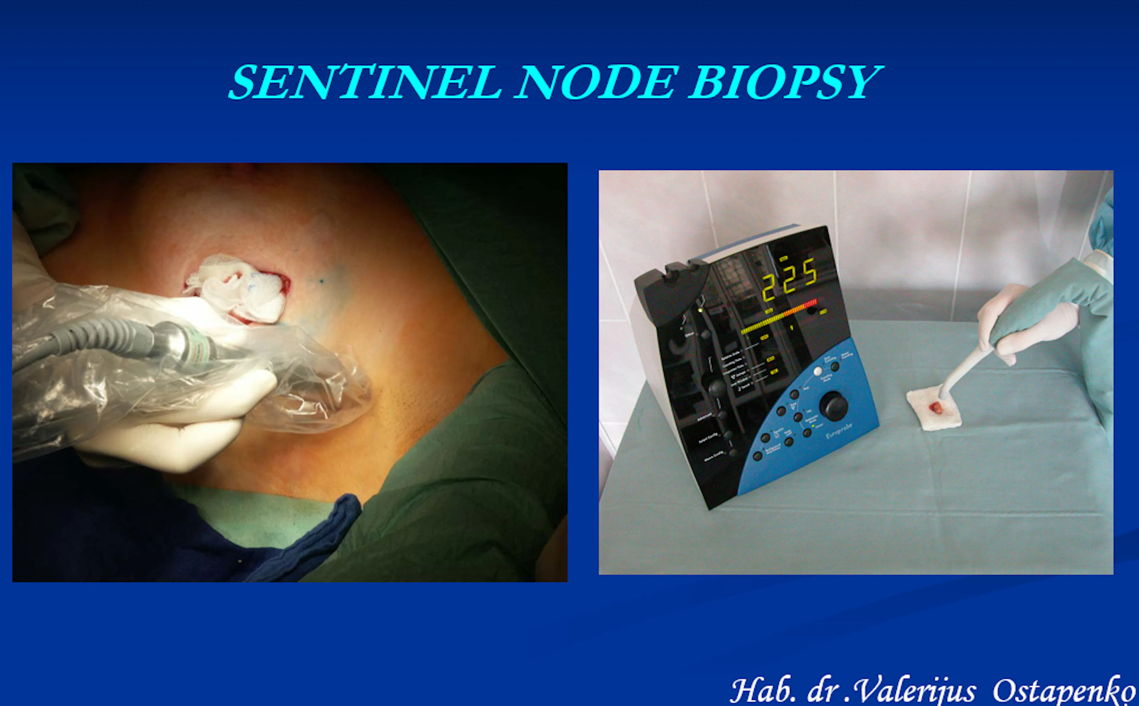 Skaidrė iš V. Ostapenko pranešimo apie sarginio limfmazfio biopsija 99 mTc.