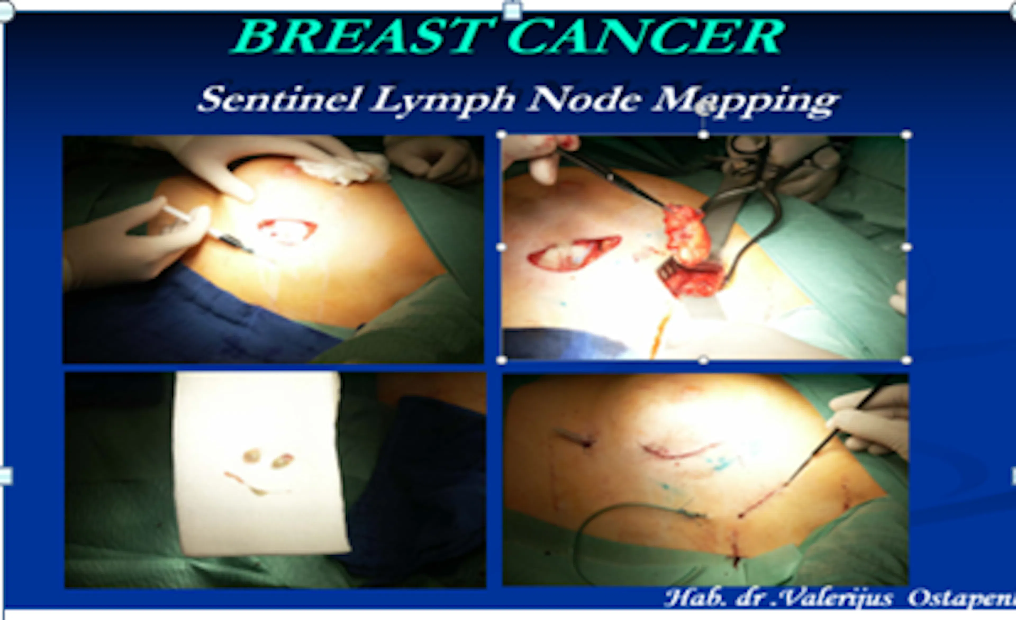 Pirmoji Baltijos šalyse SLB  su dažais (patent blue)