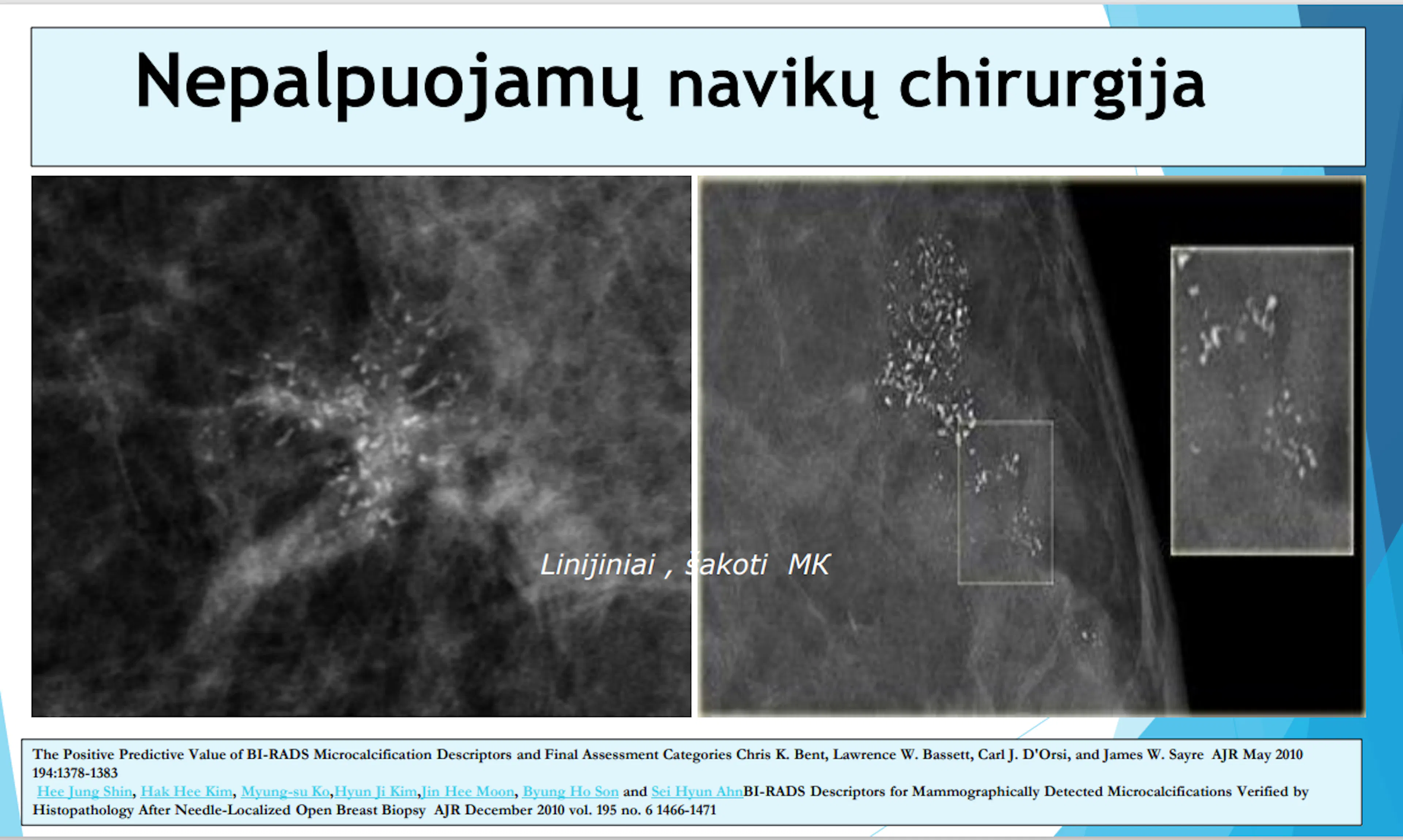 Skaidrė iš V. Ostapenko pranešimo apie krūtų nepalpuojamus navikus