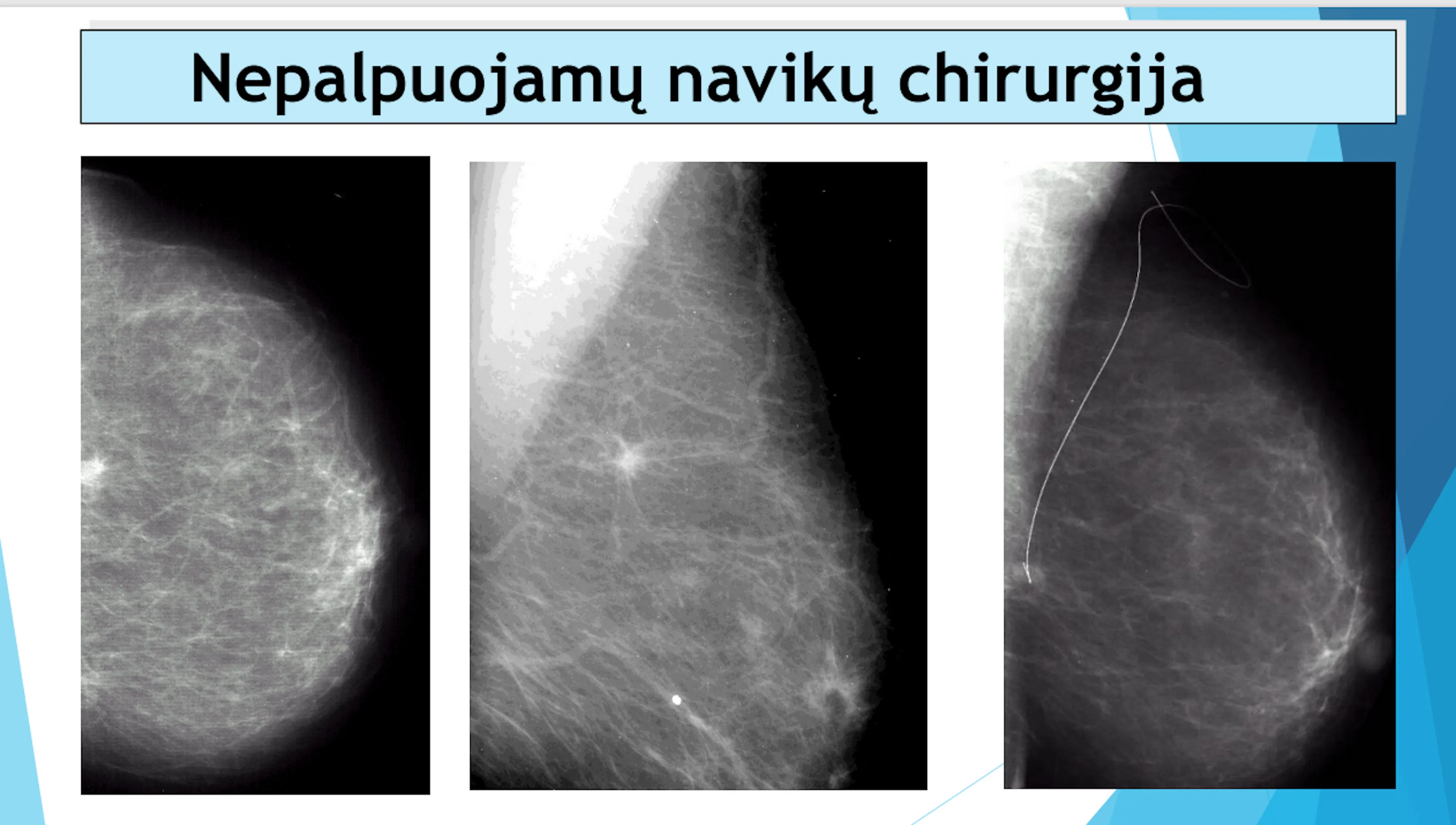 Skaidrė iš V. Ostapenko pranešimo apie krūtų nepalpuojamus navikus