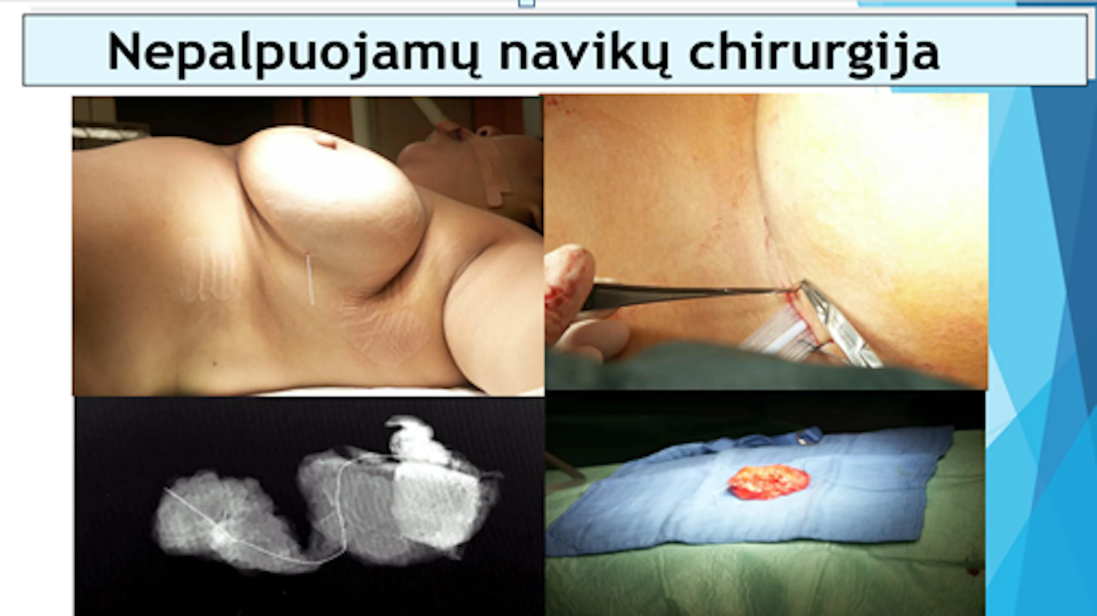 Skaidrė iš V. Ostapenko pranešimo apie krūtų nepalpuojamus navikus