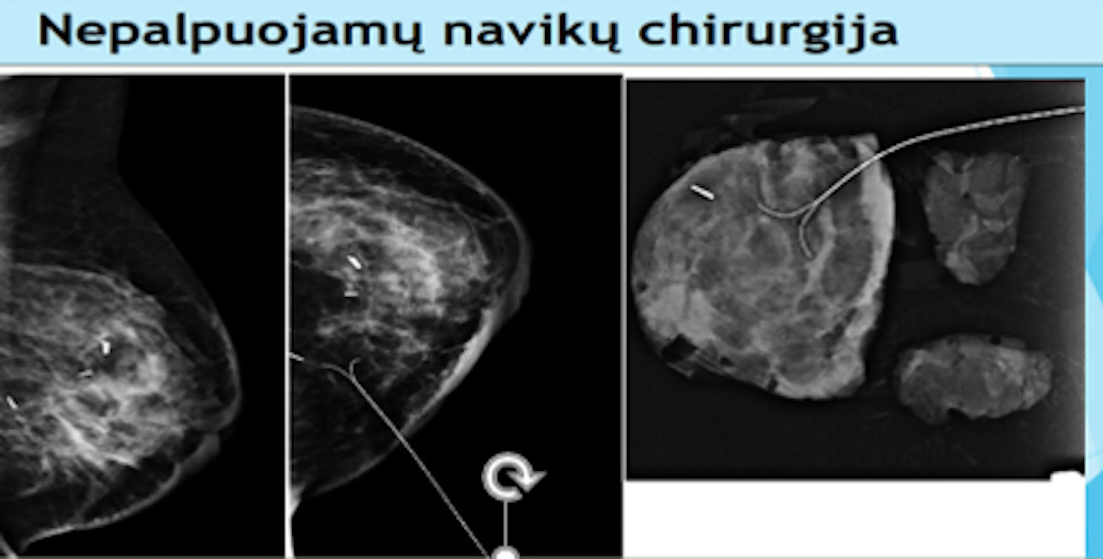 Skaidrė iš V. Ostapenko pranešimo apie krūtų nepalpuojamus navikus