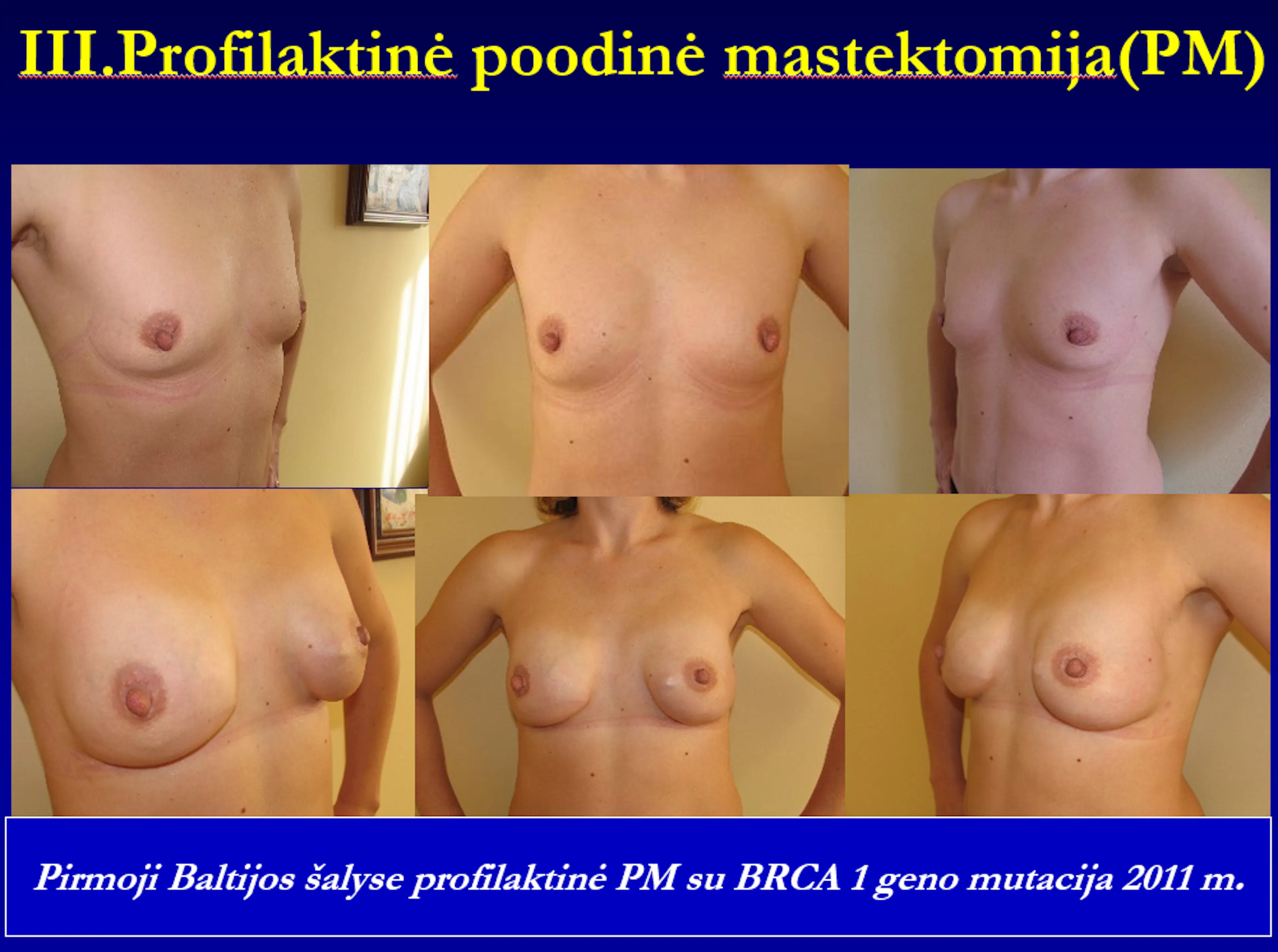 Skaidrė iš V. Ostapenko pranešimo „Paveldimas krūties vėžys ir profilaktinė mastektomija“