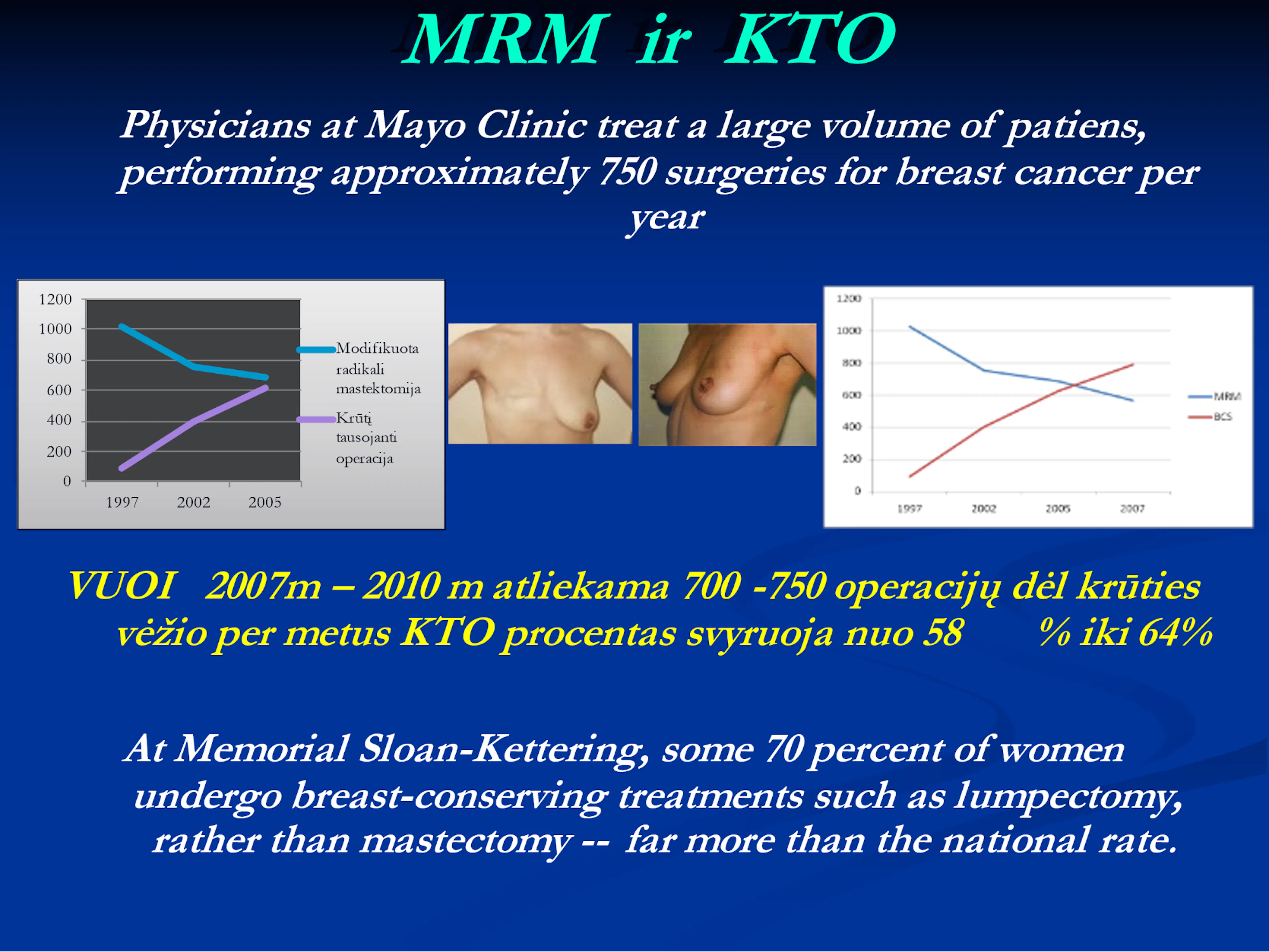 Skaidrė iš V. Ostapenko pranešimo „Krūties vėžio chirurginio gydymo evoliucija“