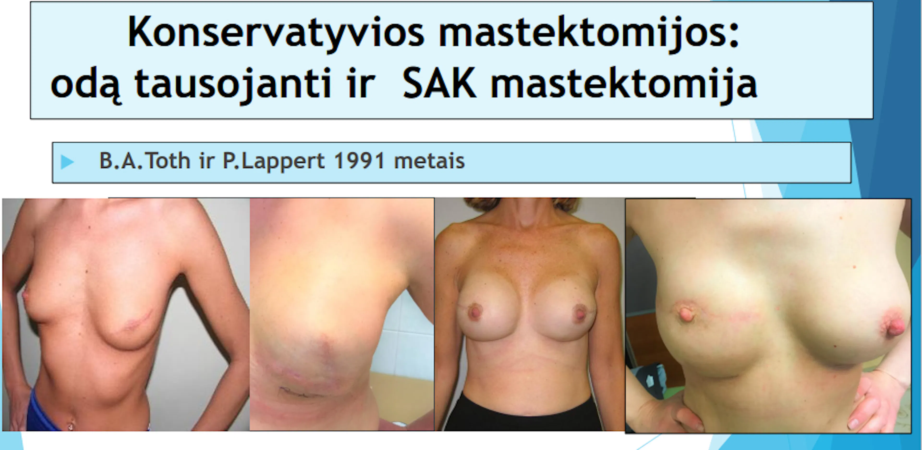 Skaidrė iš V. Ostapenko pranešimo „SAK tausojanti mastektomija su rekonstrukcija implantu“