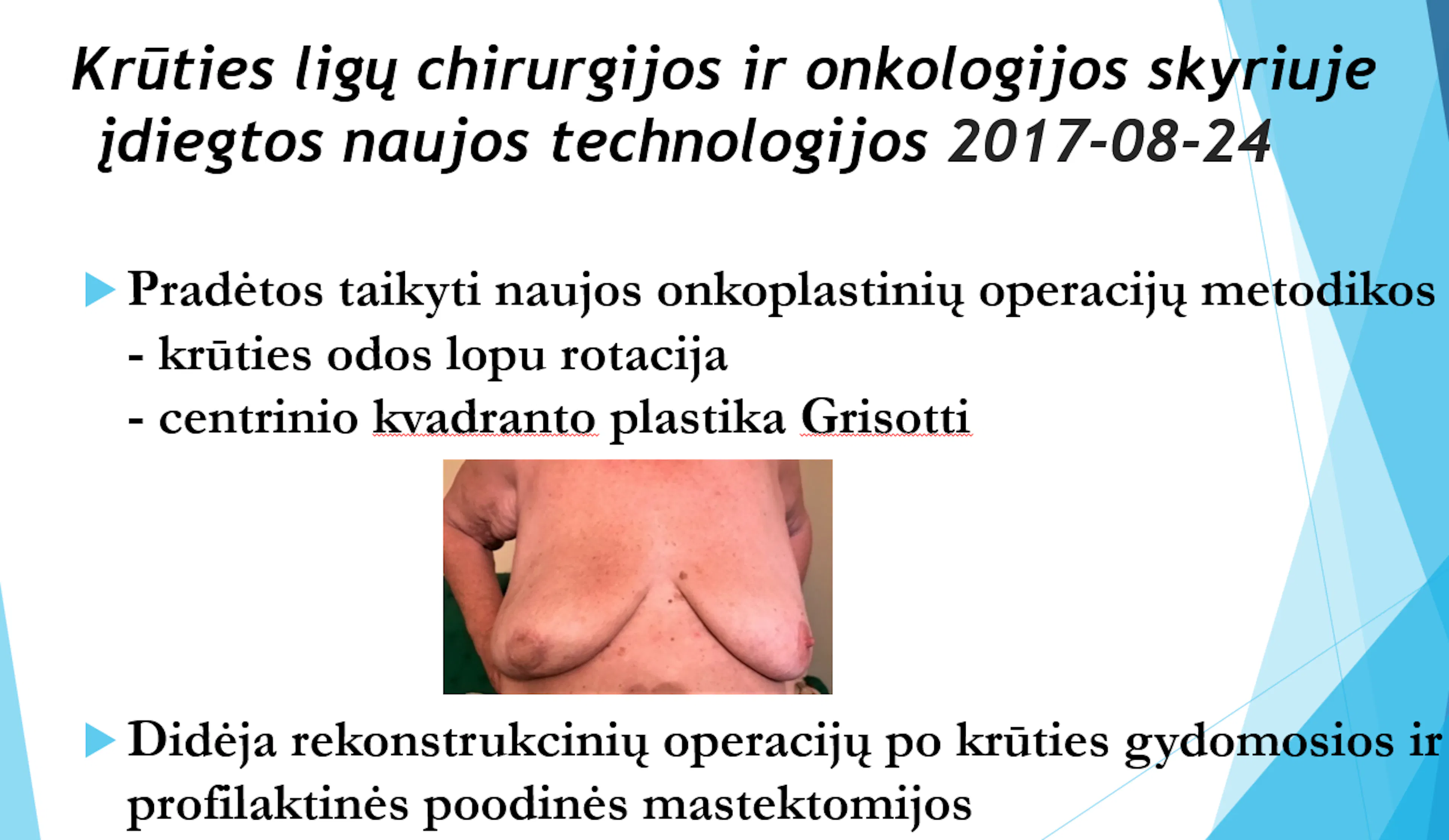 2017 m. įdiegtos naujos onkoplastinių operacijų technologijos Krūties ligų ir onkologijos skyriuje.
