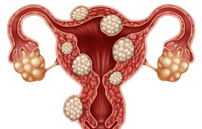 Embolizarea fibroamelor uterine – Spitalul Universitar de Urgenţă Militar Central Dr. Carol Davila
