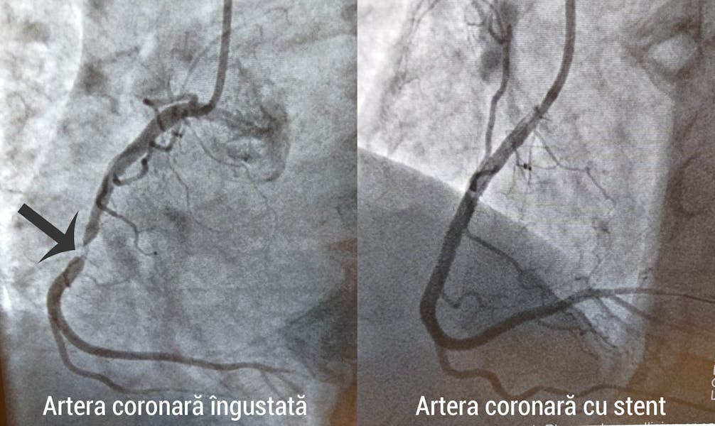 Angioplastia - când este recomandată?