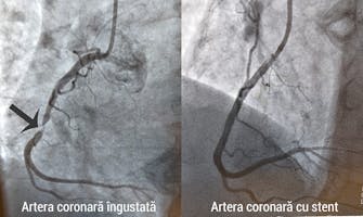 Angioplastia - când este recomandată?