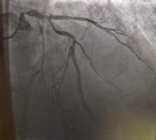 Despre Coronarografie - ce este și cât durează o astfel de procedură?