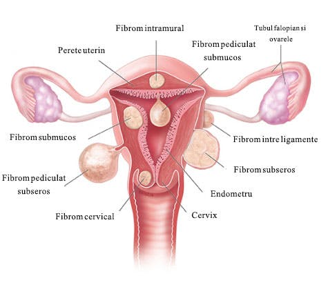 Tipuri de fibroame - tratament fibrom uterin - embolizare fibrom uterin