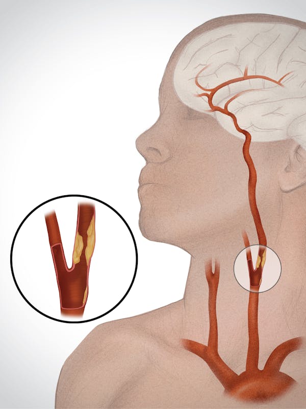 Ateroscleroza carotidiană – cauze, simptome, tratament