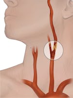 Stenoza arterelor carotide - cauze, simptome tratament