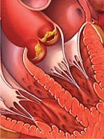 Endocardita - cauze, simptome, tratament