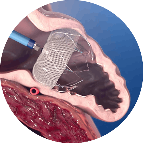 Dispozitivul Watchman