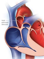 Stenoza pulmonară – cauze, simptome, tratament