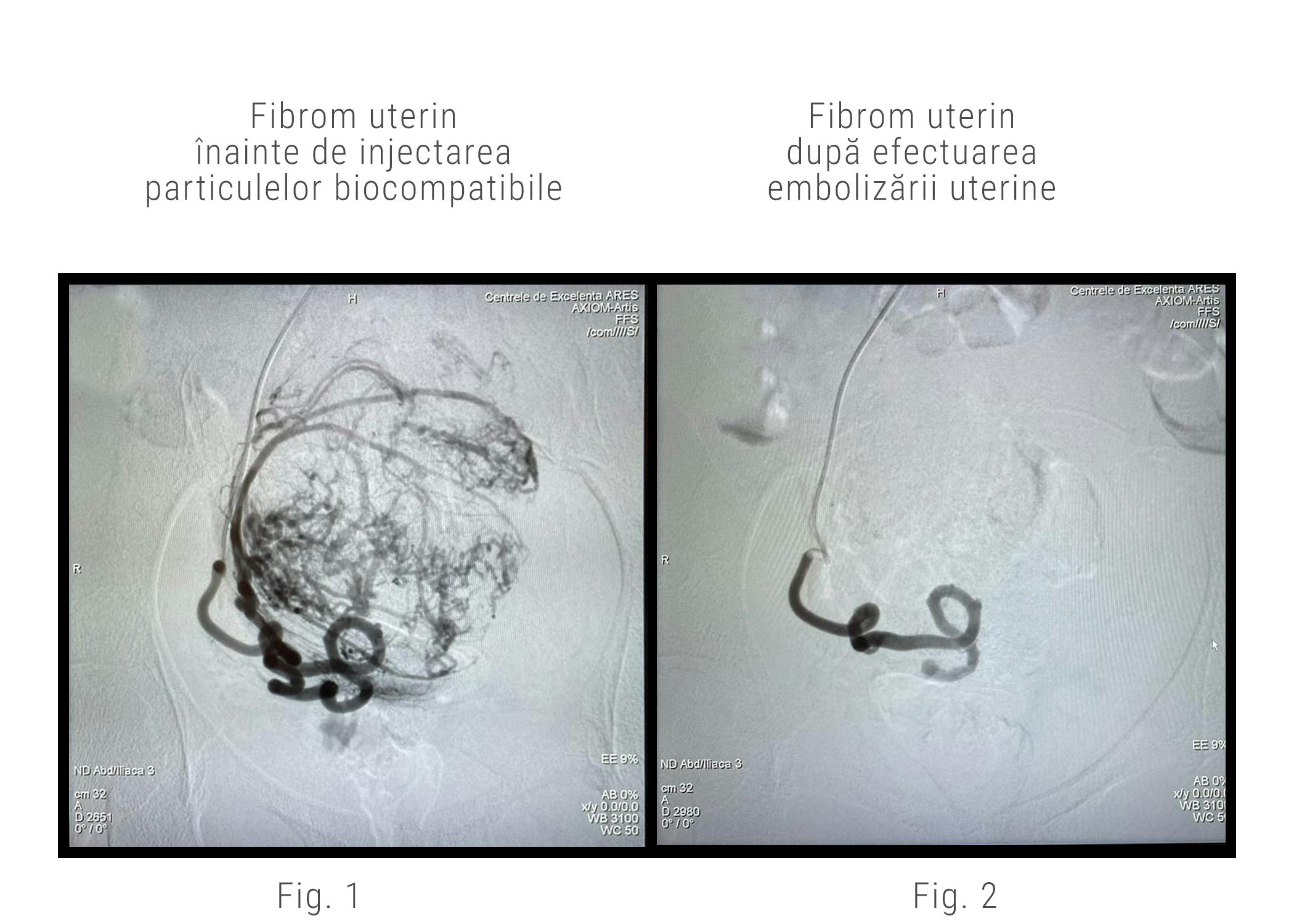 Imagine angiografica a fibromului uterin inainte si dupa embolizare