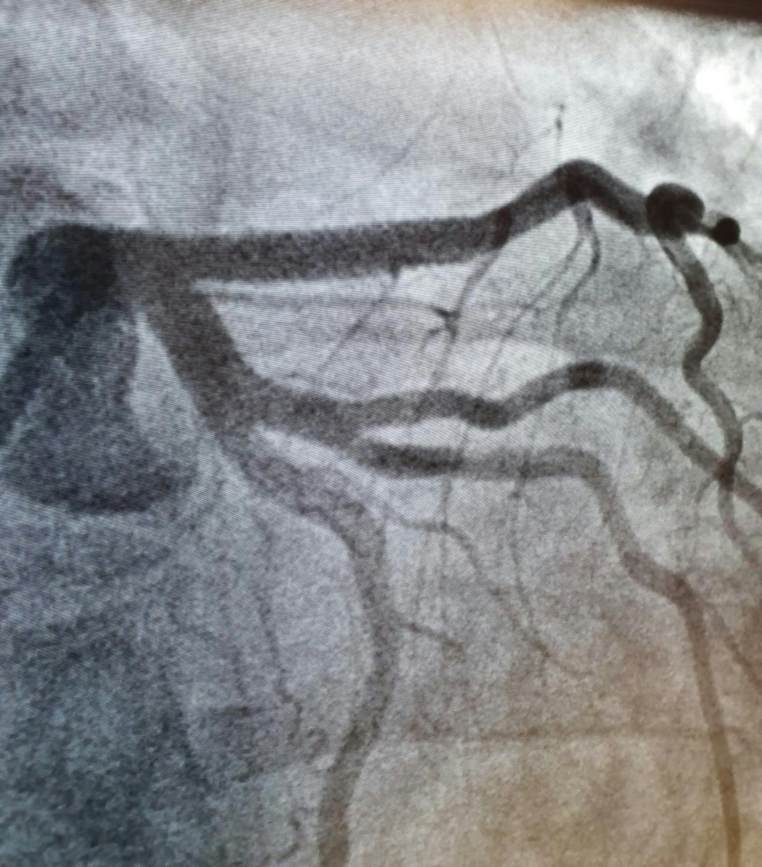 După implantarea de stent
