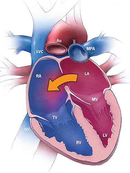 Defectul septal atrial (DSA)- cauze, simptome și tratament