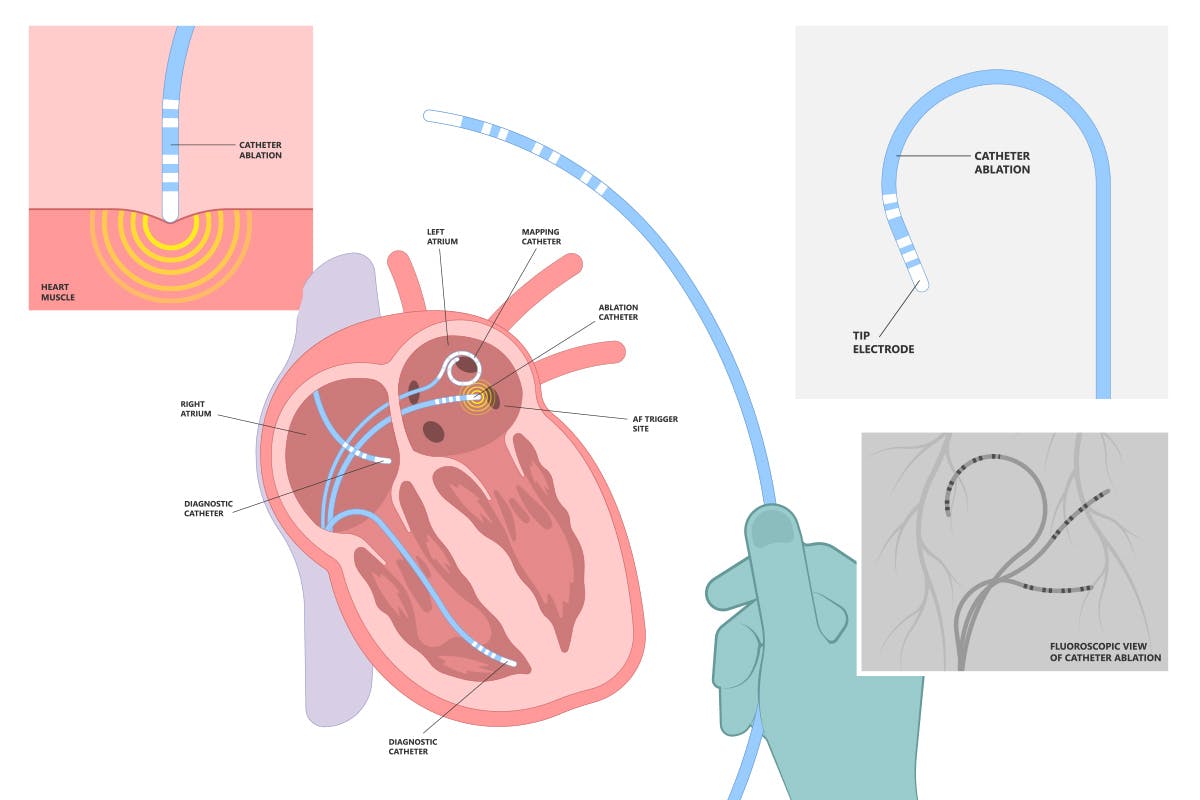 Desen tehnic ablatie cu radiofrecventa pentru firbilatia atriala