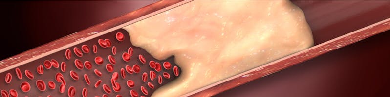 Când este nevoie să îți faci o coronarografie?