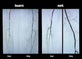 Salvat de la amputație cu ajutorul Shockwave - Premieră ARES