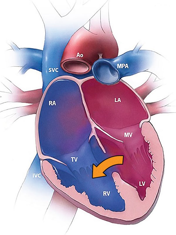 Defectul septal ventricular (DSV) - cauze, simptome și tratament