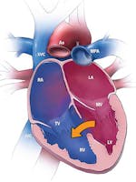 Defectul septal ventricular (DSV) - cauze, simptome și tratament