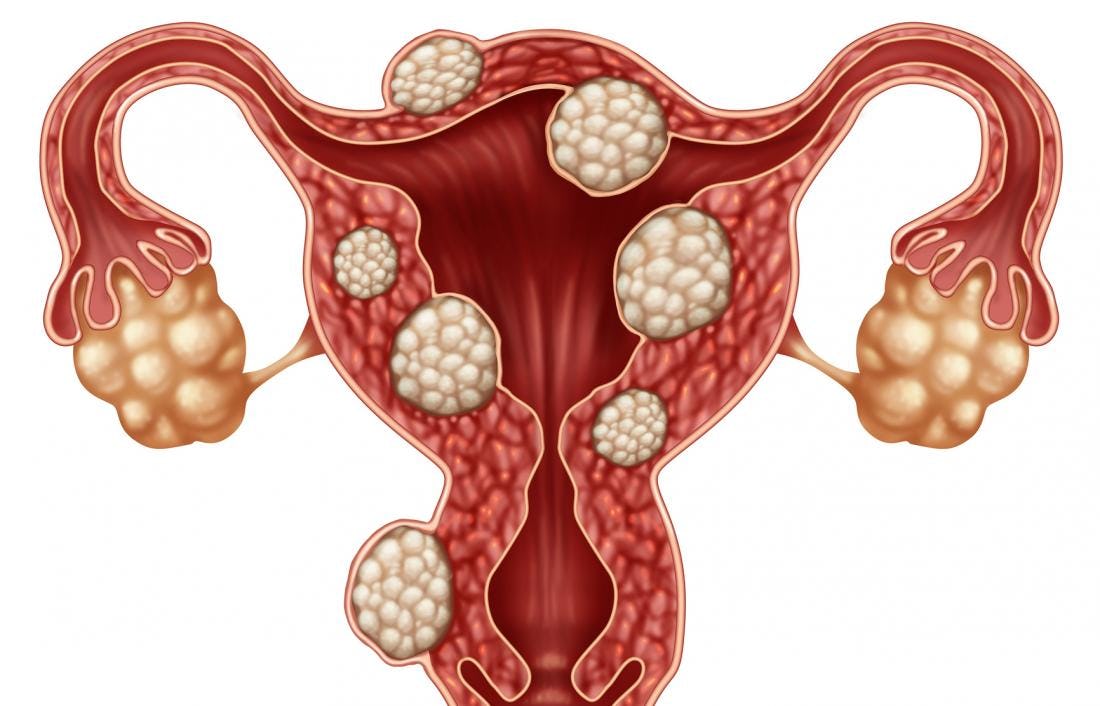 Ai fibrom uterin? Când este recomandat să aplici metoda "Urmărește și Așteaptă"?