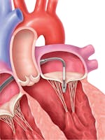 Insuficiența mitrală (regurgitarea mitrală) - cauze, simptome și tratament