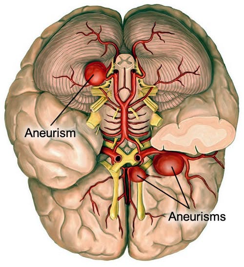 Аневризма мозга отзывы. Аневризма сосудов головного мозга локализация. МИЛЛИАРНАЯ аневризма головного мозга. Локализация аневризм сосудов головного мозга. Типа аневризма головного мозга.