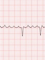 Flutter atrial - cauze, simptome și tratament