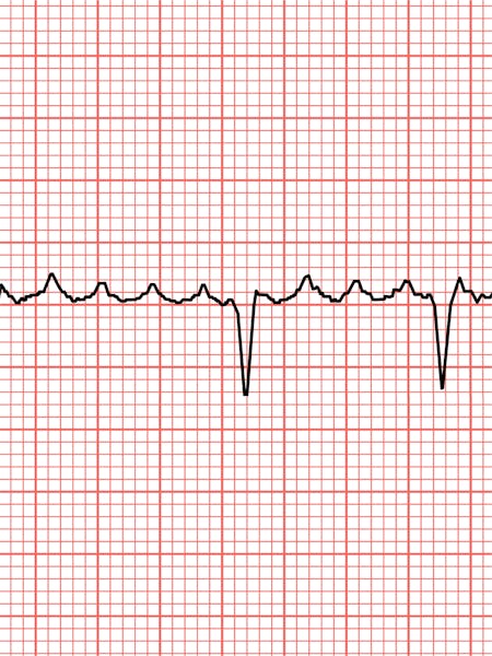 Flutter atrial - cauze, simptome și tratament