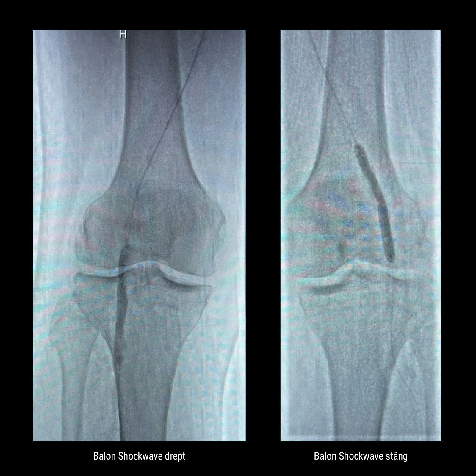 Imagine angiografică cu balon Shockwave