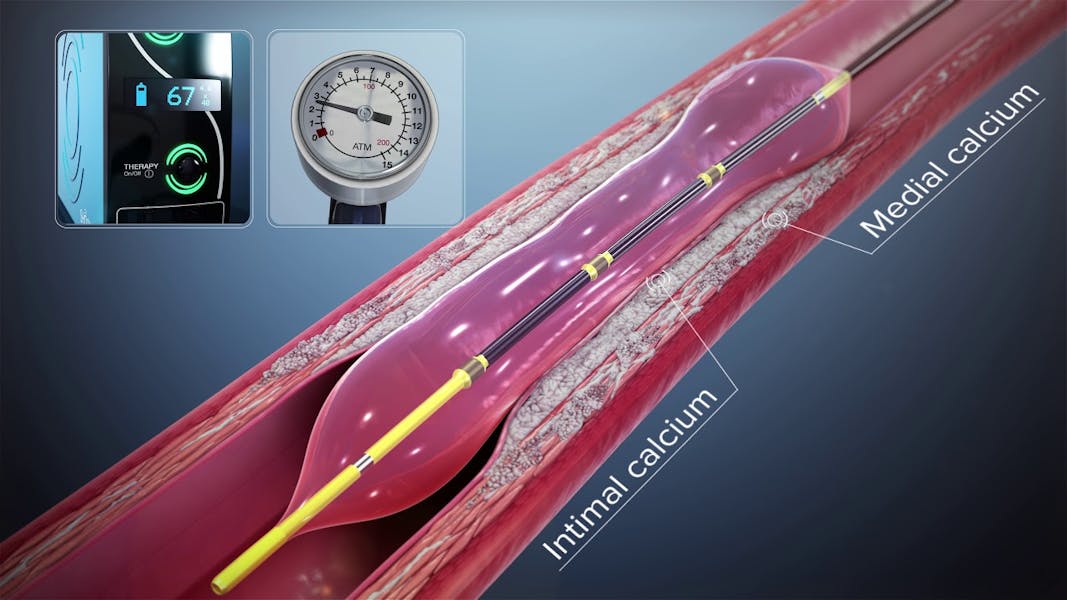 Terapia Shockwave - În premieră în România și doar la Centrele Ares