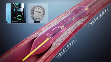 Terapia Shockwave - În premieră în România și doar la Centrele Ares