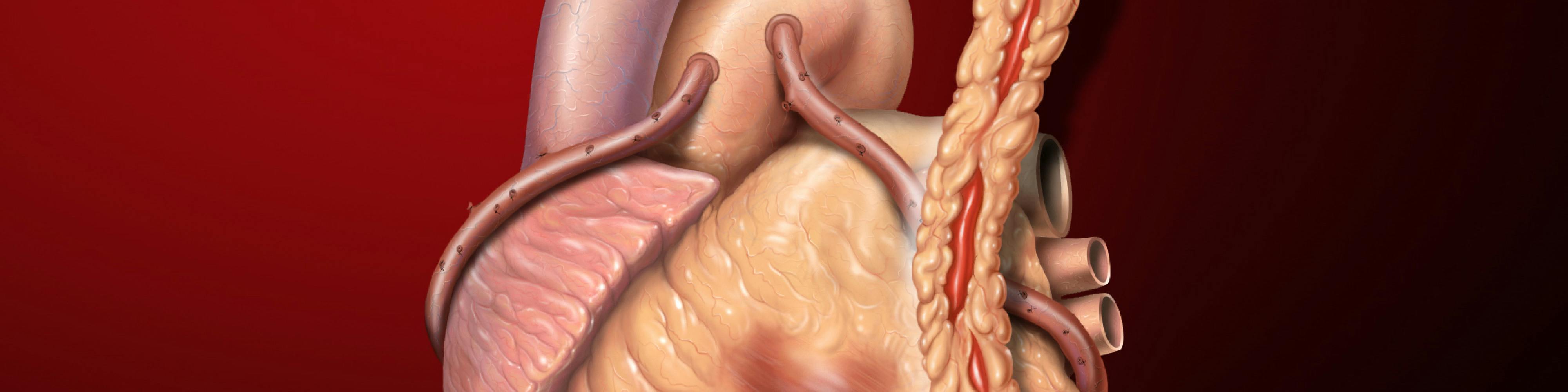 Interventia de bypass aorto-coronarian pentru cardiopatia ischemica | Monza Ares