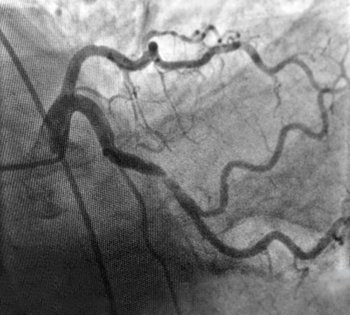 Angiografie coronariană înainte de intervenție | Durere toracică generată de stenoză | Centrele ARES